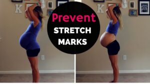 How to prevent stretch marks while pregnant